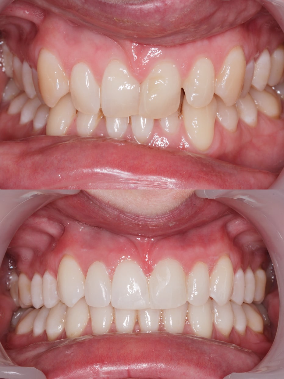 Invisalign results - smile works