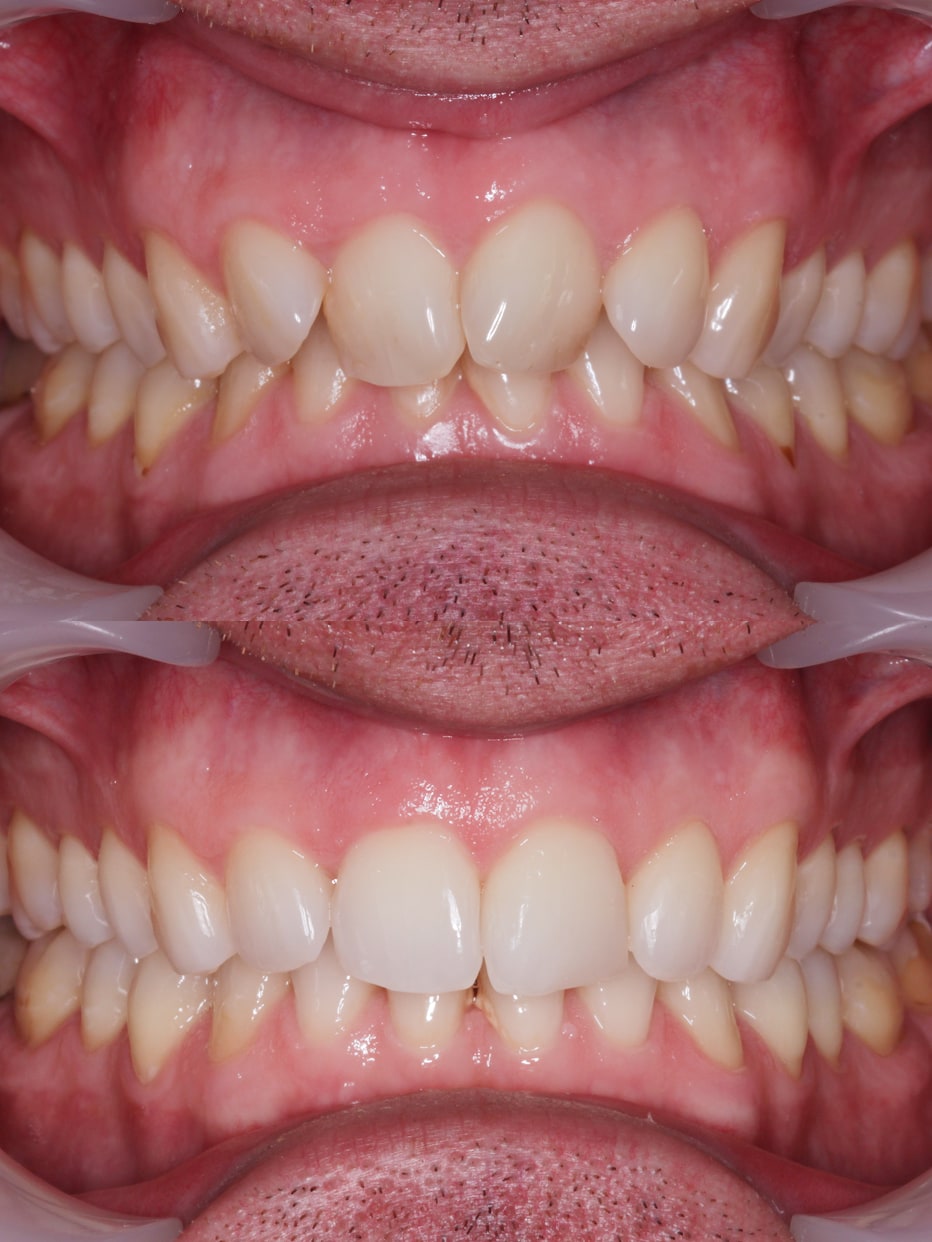 Invisalign results - smile works