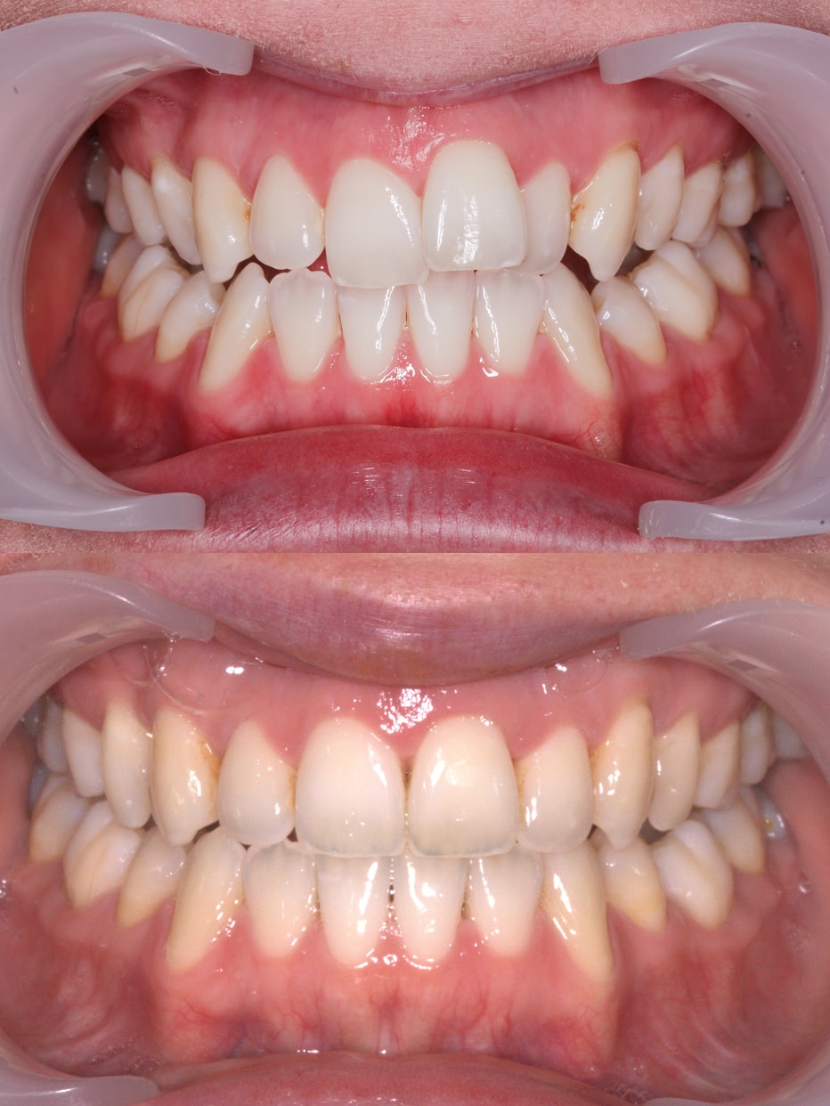 Invisalign results - smile works