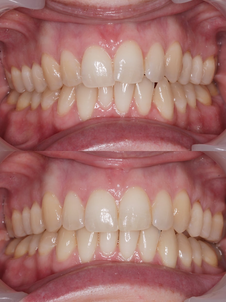 Invisalign results - smile works