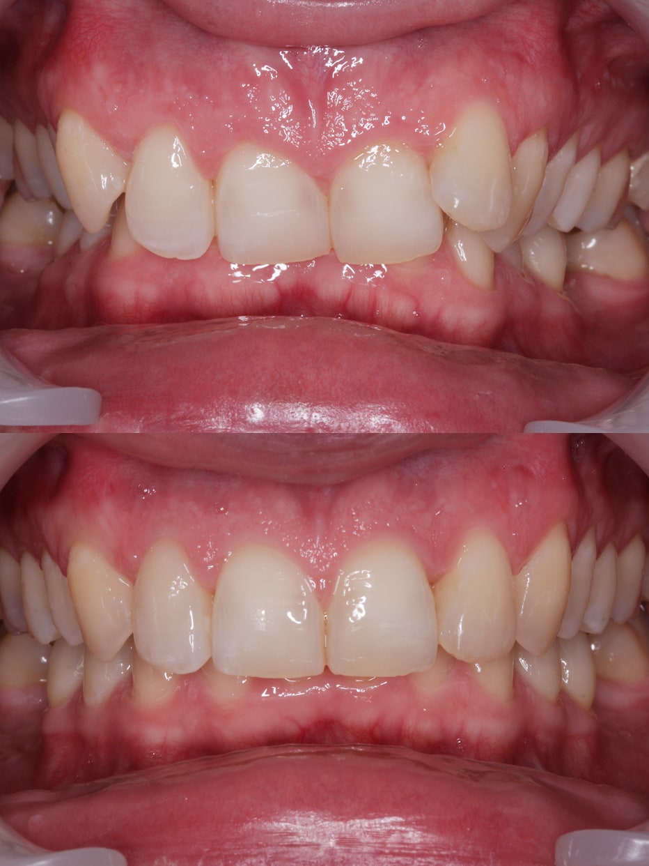 Invisalign results - smile works