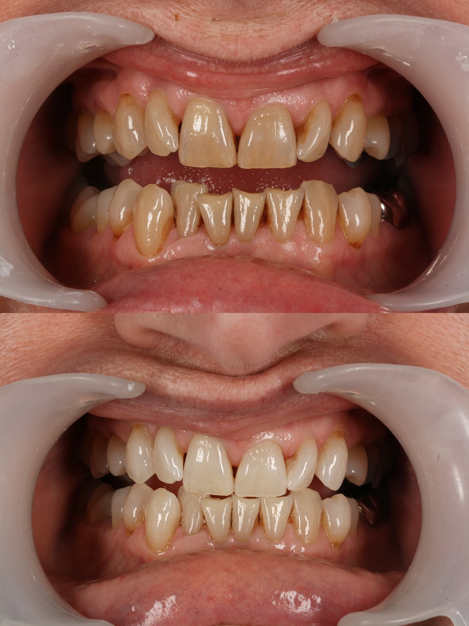 Invisalign results - smile works