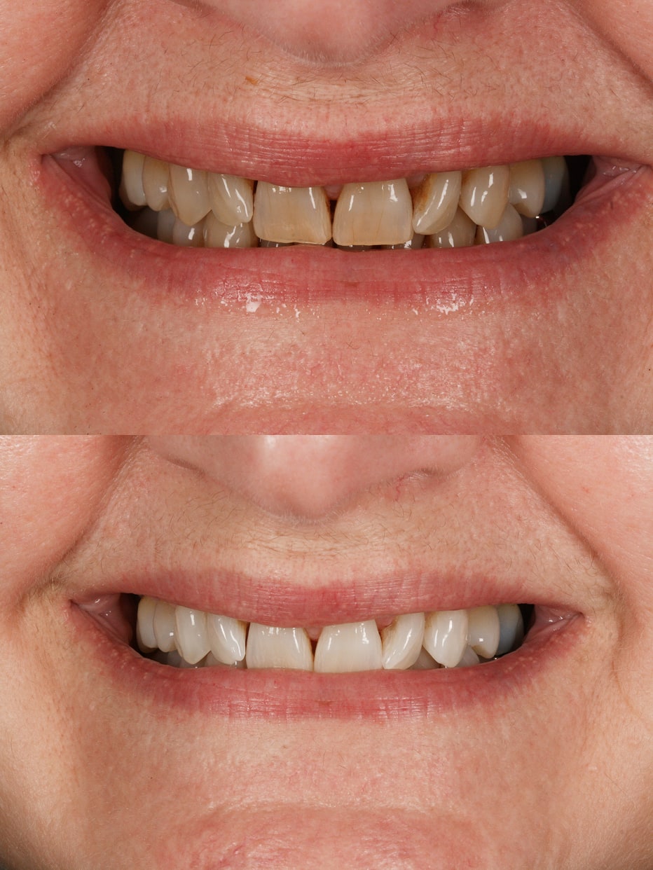 Invisalign results - smile works