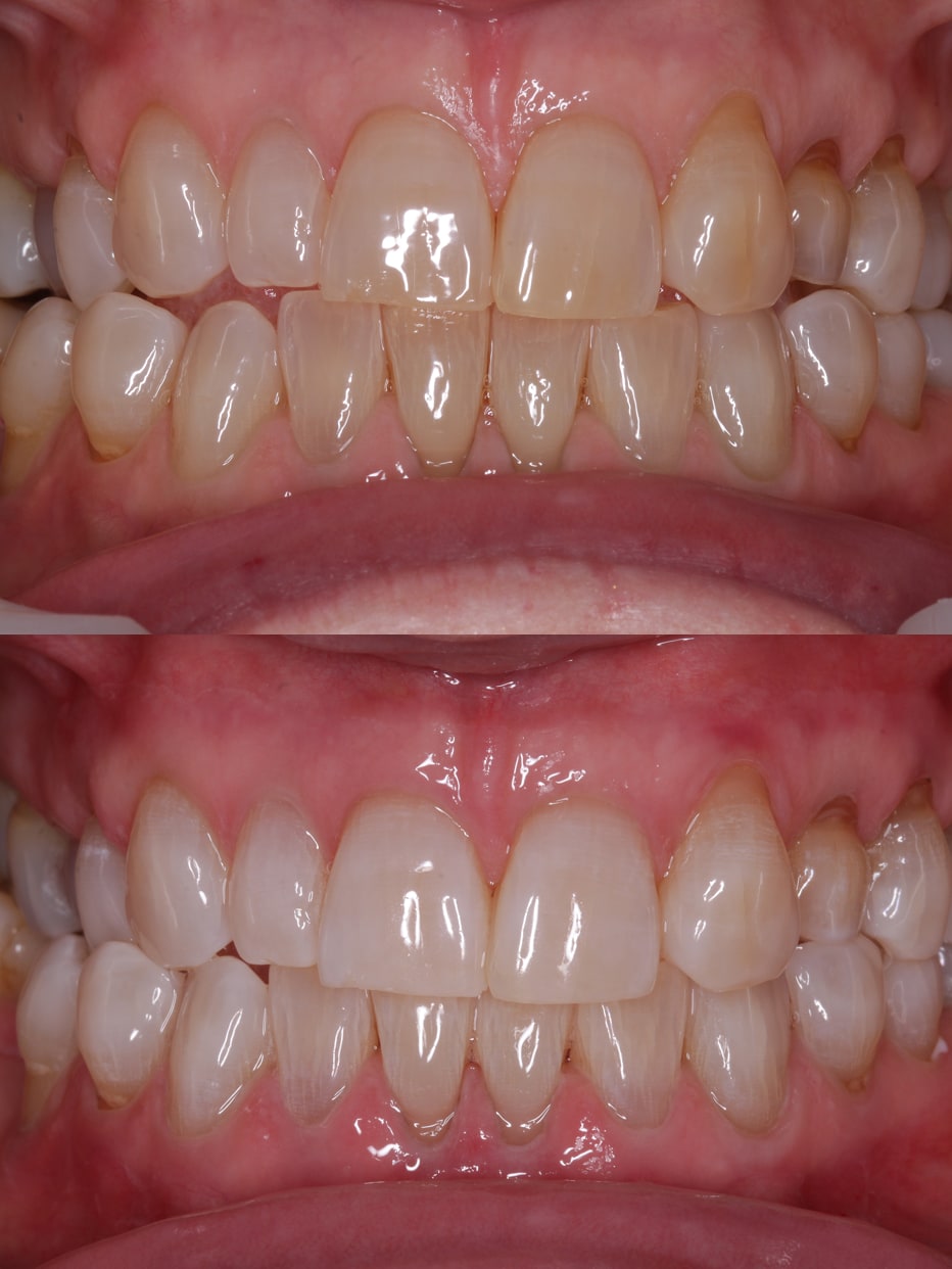 Invisalign results - smile works